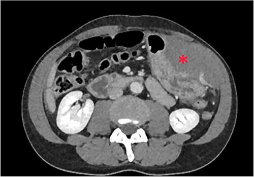 Intramural hematoma in anterior stomach wall.