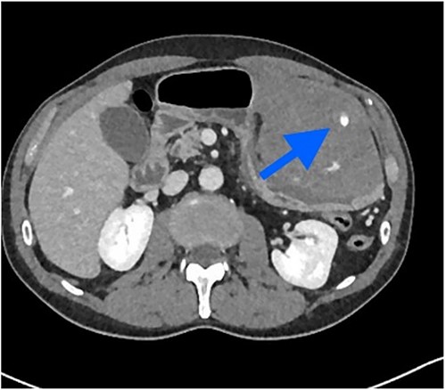 Contrast extravasation in hematoma.