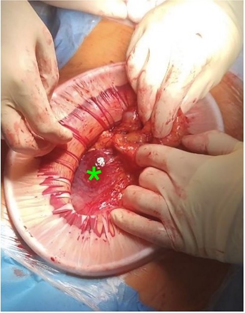 Intramural hematoma in anterior stomach wall.