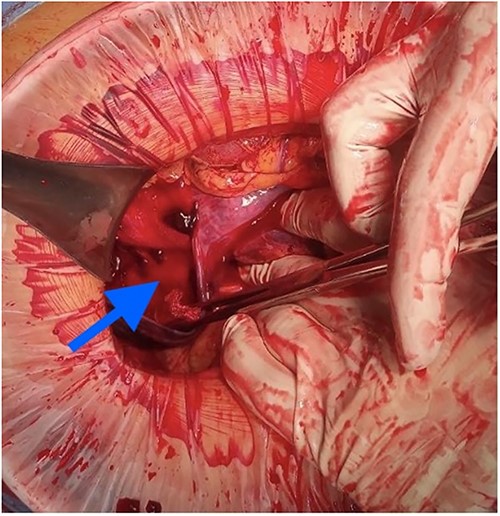 Active bleeding in the hematoma cavity.