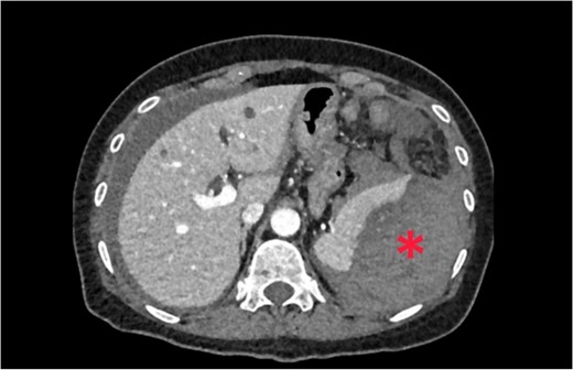 Large perisplenic hematoma.