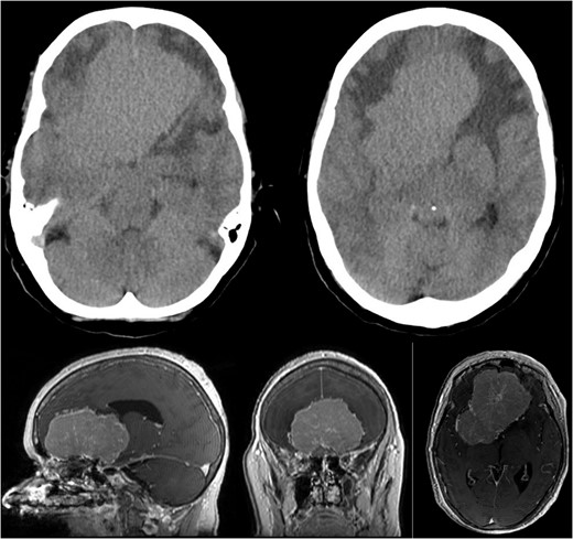 Showing the CT imaging with a hypodense fronto-basal lesion with finger-shaped perifocal edema and the T1-weighted MRI image with homogenous contrast-enhancing frontobasal lesion demonstrating mild compression on both lateral ventricles and posterior displacement of the right middle cerebral artery (MCA) without evidence of hydrocephalus.