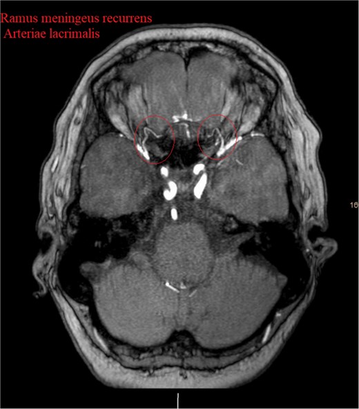 Show the MRA with the bilateral anastomotic branch of the lacrimal artery with the middle meningeal artery.