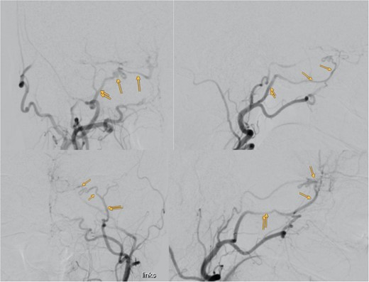 Showing the digital subtraction angiography of the left external carotid artery in four perspectives: posteroanterior view (upper left), lateral view (upper right), posteroanterior view (lower left), and lateral view (lower right). Additionally, the figure shows the middle meningeal artery and the anastomosis, which are marked.