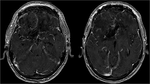 Showing the postoperative T1-weighted MRI with no residual tumor tissue.
