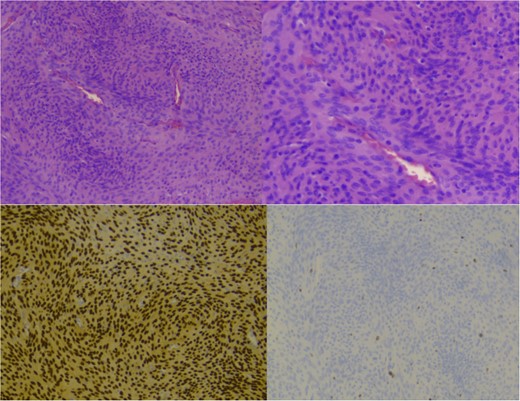 Showing staining with hematoxylin and eosin, low power lens (upper left), high power lens (upper right) and moleculopathological analysis with ki67 (lower left), progesteron receptor (lower right).