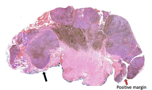 Histopathology slide with involved peripheral margin, labelled ‘Positive margin’.