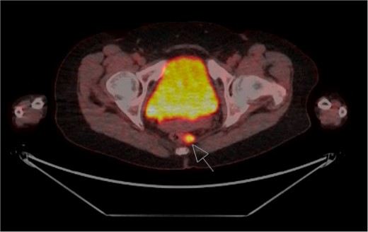 FDG-PET staging scan with enlarged FDG-avid mesorectal lymph nodes (arrow).