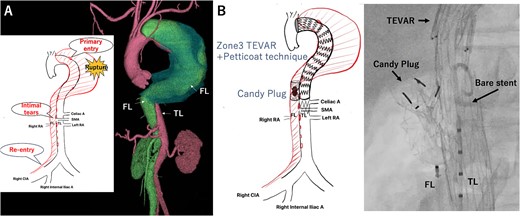 Preoperative computed tomography 3D reconstruction showing the FL extended from the descending aorta to the right common iliac artery. The schema showing multiple intimal tears at thoracic and abdominal levels (A). Intraoperative angiography showing Candy plug made with Excluder aortic extender and AMPLATZER Vascular Plug II deployed in the FL at the level of bare stent of Zenith TX-D in the TL (B). TL: true lumen FL: false lumen RA: renal artery CA: celiac artery SMA: superior mesenteric artery TEVAR: thoracic endovascular aortic repair.