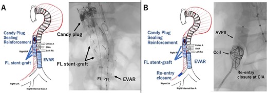 Intraoperative angiography showing the Excluder deployed in the FL closing intimal tears neat the renal artery (A). The re-entry at the CIA was closed with AMPATZER Vascular Plug II and Interlock microcoils (B). TL: true lumen FL: false lumen RA: renal artery CA: celiac artery SMA: superior mesenteric artery CIA: common iliac artery.