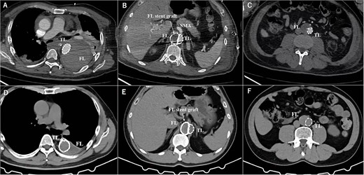 The postoperative contrasted computed tomography at thoracic level (A), at SMA level (B), at abdominal level (C). The computed tomography three years after the operation at thoracic level (D), at SMA level (E), at abdominal level (F). TL: true lumen FL: false lumen RA: renal artery CA: celiac artery SMA: superior mesenteric artery CIA: common iliac artery.