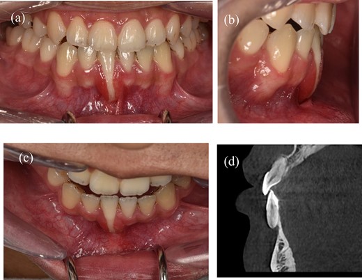 A 22-year-old man exhibits gingival recession in the lower left central incisor. (a) Intraoral image illustrating the labial view. (b) Intraoral image illustrating the lateral view. (c) Intraoral image illustrating the bird’s-eye dental view. (d) CBCT radiograph capturing the recession region.