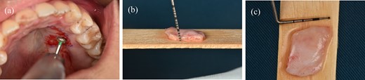 (a) The process of deepithelialization at the hard palate involves the utilization of a high-speed handpiece. (b) The thickness of a subepithelial connective tissue graft. (c) The dimensions of a subepithelial connective tissue graft.