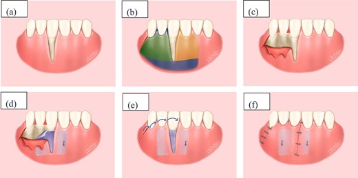 Illustrative depiction of the surgical procedure (a) Initial condition. (b) Flap design in the recipient area: yellow area represents tunnel incision, blue area represents split-thickness flap, and green area represents full-thickness flap. (c) Full-thickness flap. (d) Stabilize the connective tissue graft. (e) Rotate the flap and reposition the gingival margin. (f) Suture the flap.