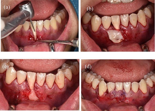 (a) Preparing the tooth surface using a high-speed handpiece. (b) Unilateral tunneling technique. (c) Stabilize the connective tissue graft. (d) Rotate the flap and reposition the gingival margin.