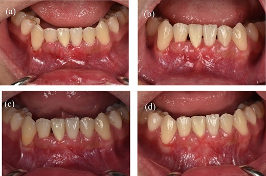 Clinical images of postoperative follow-up. (a) 3 weeks. (b) 2 months. (c) 6 months. (d) 12 months.