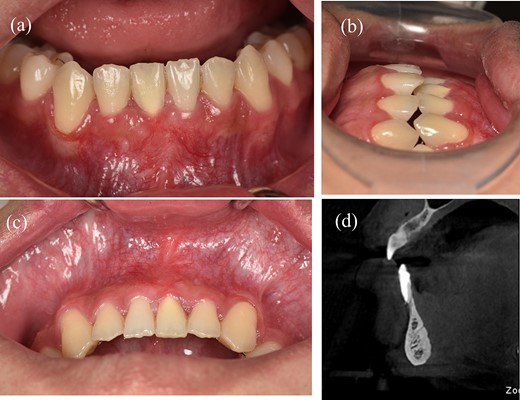 Results of treatment after one year of follow-up. (a) Intraoral image illustrating the labial view. (b) Intraoral image illustrating the lateral view. (c) Intraoral image illustrating the bird’s-eye dental view. (d) CBCT radiograph capturing the recession region.