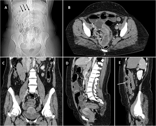 Scannogram (A) showing dilated small bowel loops in central abdomen (black arrows). Axial (B), coronal (C) and sagittal (D, E) images of contrast CT showing telescoping of pelvic ileal loop (dotted white arrows) with upstream small bowel obstruction (solid white arrow).