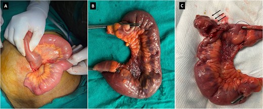 Intraoperative image showing the small bowel segment with ileo-ileal intussusception (A). Surgical specimen (B) showing the resected ileal segment. Surgical specimen (C) showing polypoid lesion (black arrows).