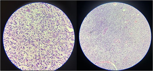 Histopathological examination reveals spindle-shaped cells within a loose, fibromyxoid background. The infiltrate of inflammatory cells, predominantly eosinophils and the presence of variably sized blood vessels are also evident.