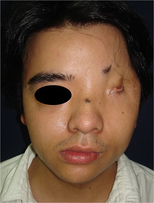 A 24-year-old male presents with a Tessier 10 cleft, eyelid deformity, blepharophimosis, and a missing lateral half of the eyebrow.