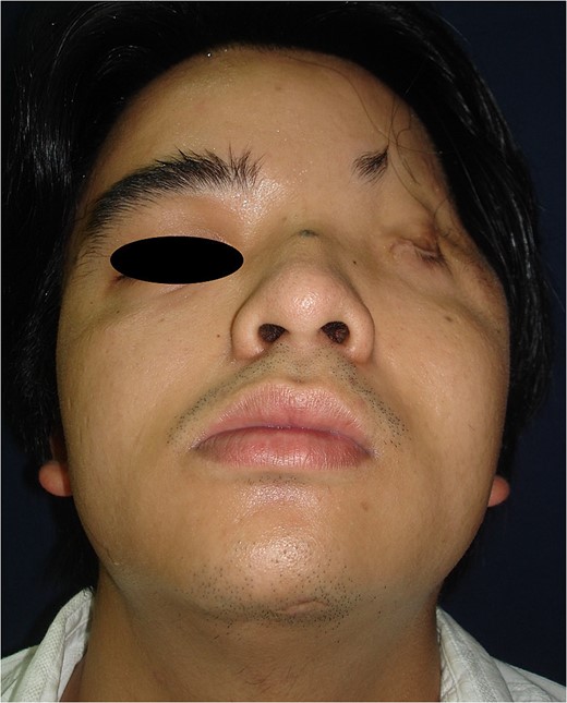 Hypoplasia in the left frontotemporal area.