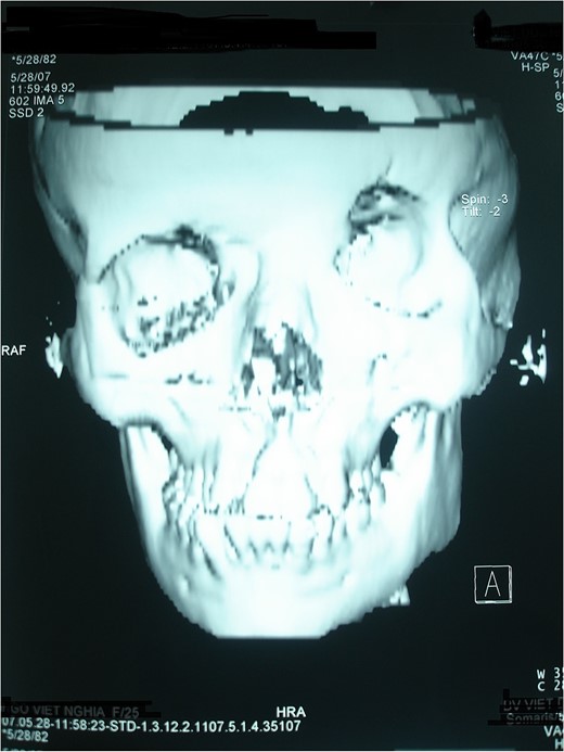 Missing bony cleft on magnetic resonance imaging.