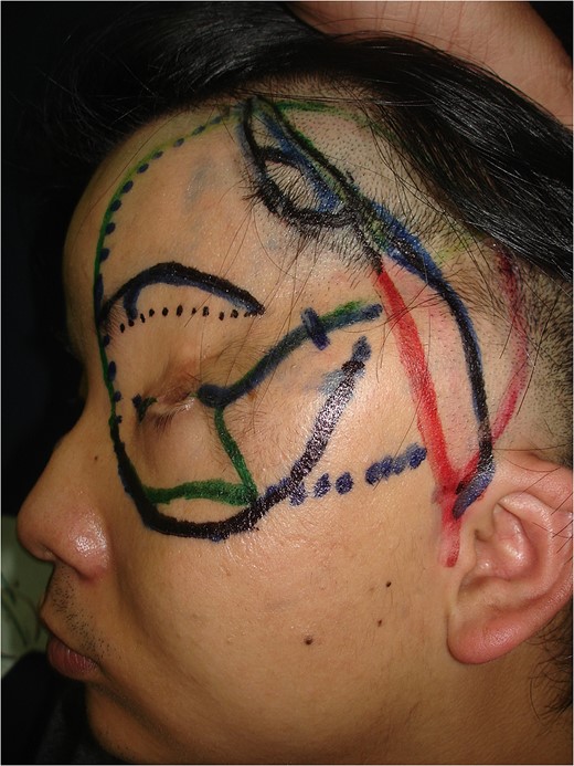 Preoperative design with superficial temporal artery island flap.