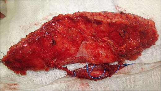 The ALT flap harvested measured 9 × 15 cm with three perforators.