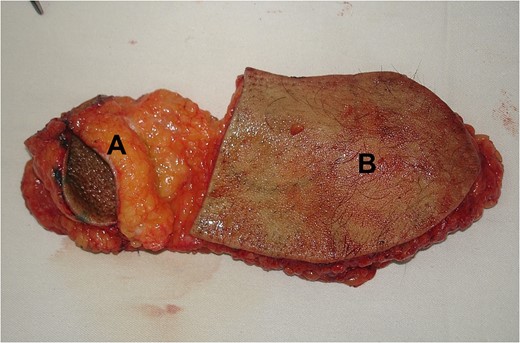 Skin paddle (A) to recreate the eye socket; an adipofascial flap (B) to fill the frontotemporal area volume.