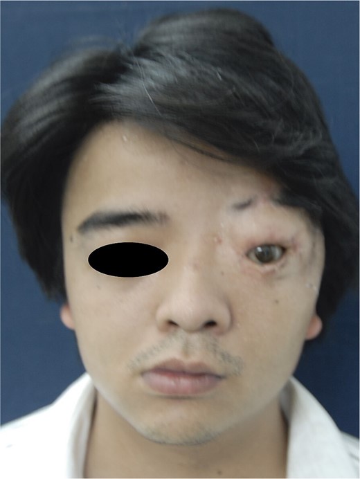 Postoperative result after 16 months: front view.