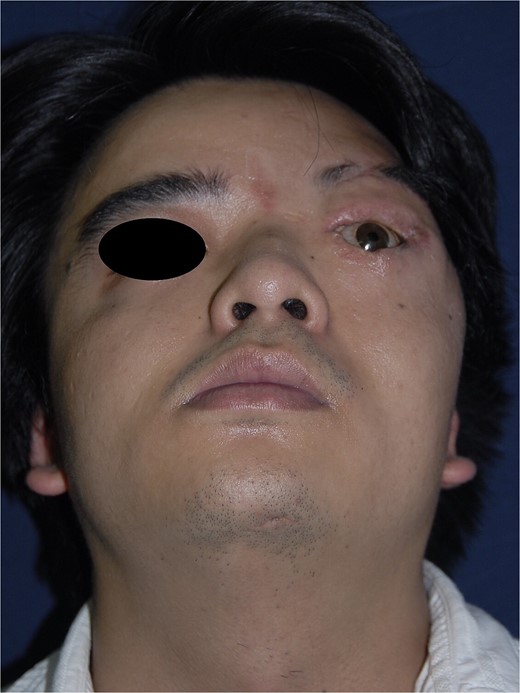 Postoperative result after 16 months: inferior–superior view.