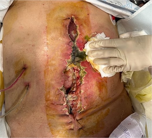 Complication of an open abdomen on 7 days after extensive surgery for ovarian cancer.