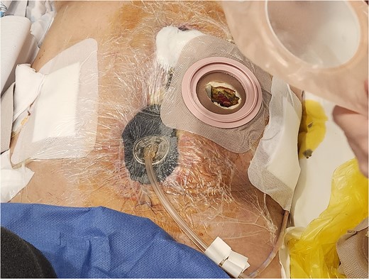 VAC dressing was applied to the open abdominal wound for 26 days.