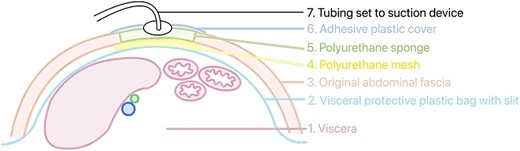 Schematic diagram of VAC system application on a patient.