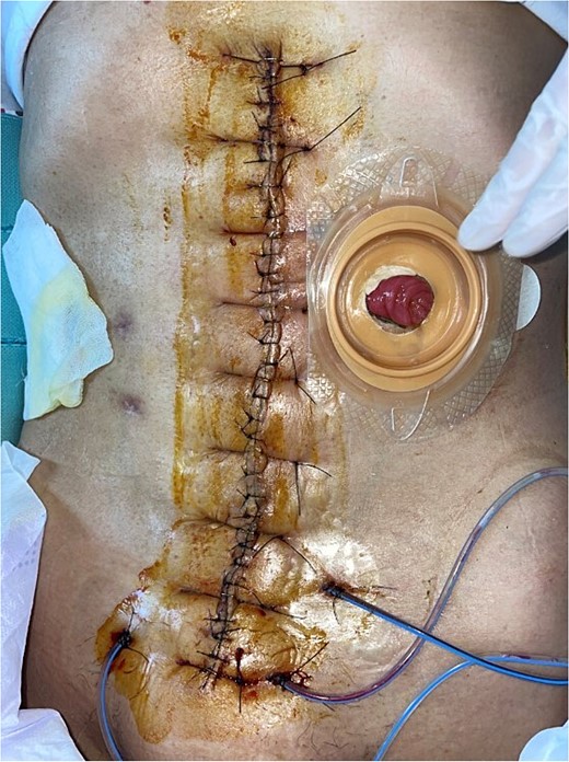 Repeated debridement and primary closure were performed on 1 month postoperatively.