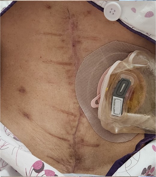 Wound healing was achieved on 2 months postoperatively.