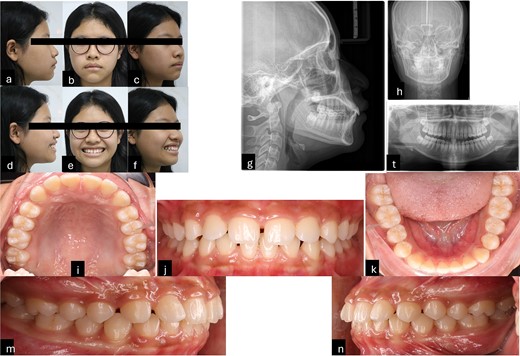 Pre-treatment records. (a–f) Extra oral pictures; (g–t) pre-treatment radiographies; (l–n) intraoral pictures.