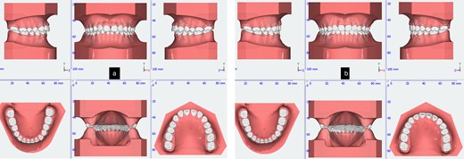 3D simulation of pre-treatment (a) and post-treatment (b).