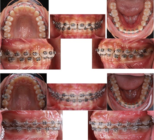 Tongue spurs bonding, alignment, leveling and space closure phase of the treatment.