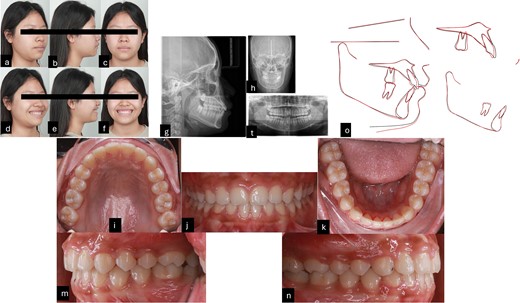 Post-treatment records. (a–f) Extra oral pictures post-treatment; (g–t) post-treatment radiographies; o: superimposition before and after treatment; (i–n) intraoral pictures post-treatment.