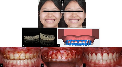(a) Smile design before gingivoplasty treatment; (b) 3D printing gingivoplasty guide; (c) 3D guide design; (d,e) gingivoplasty treatment with guide; (f) post-treatment.