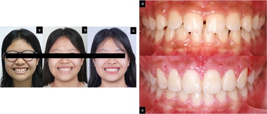 Smile of the patient. (a) Pre-treatment; (b) after orthodontic treatment; (c) after gingivoplasty treatment; (d) before treatment; (e) after 2 weeks of gingivoplasty treatment.