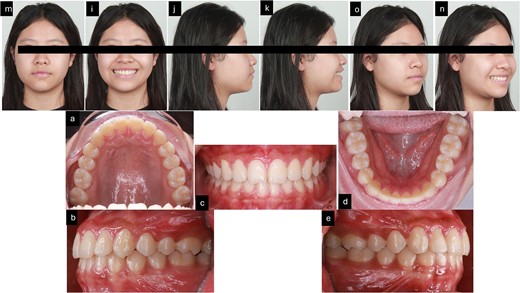 3 months follow-up after treatment. (m–n) Extra oral pictures; (a–e) intraoral pictures.