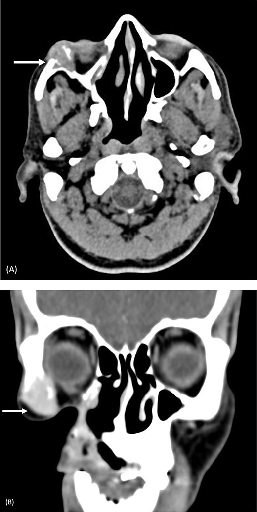 Pre-operative computed tomography of the zygomatic region. (A) Axial CT (bone algorithm) demonstrating a mass of size 2.2 × 2.1 × 2.1 cm3 in the right infraorbital region; (B) coronal CT (bone algorithm) demonstrating erosion of the lateral wall of the right orbit and right zygomatic bone, with involvement of the lateral rectus muscle.