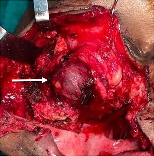 Visible tumor mass after reflection of flap.