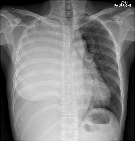 Total opacity of right hemithorax caused mediastinum shifting to the left. This finding was consistent with massive right pleural effusion.