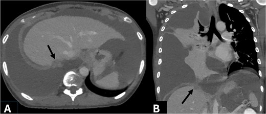 Axial (A) and coronal (B) contrast enhanced CT obtained during portovenous phase showed right subdiaphragmatic enhancing nodule attaching right hepatic capsule, measuring 15 mm (arrow). Massive complicated right pleural effusion caused compressive atelectasis at lower part of right lung. Large amount of ascites was noted.