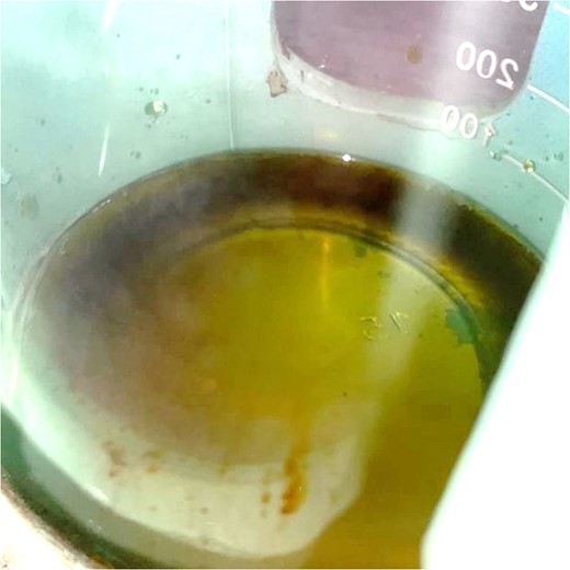 Thoracentesis revealed the presence of viscous fluid that looked like bile within right pleural cavity.