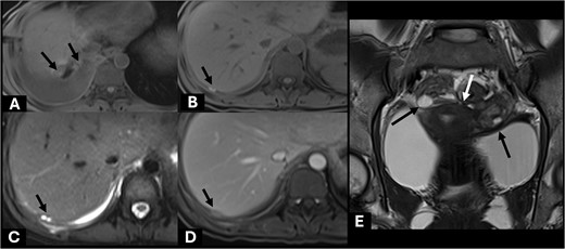 Axial precontrast T1W images (A, B) showed few subhepatic nodules (short black arrow) demonstrating hyperintensity, which measured up to 15 mm abutting posterior right hepatic capsule. It showed hyperintensity on T2W (C) and homogeneous enhancement on post contrast enhanced MRI (D). These findings are suggestive of endometriotic implant nodules with subacute hemorrhagic foci (short black arrow). Included MR pelvis on coronal T2W image (E) showed complex cystic lesions at both adnexae (long black arrow) with adjacent fibrosis (white arrow) creating kissing ovary sign appearance. These findings are compatible with pelvic DIE.